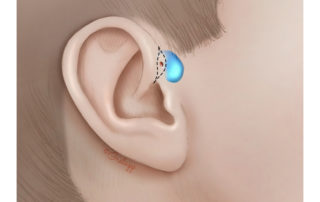 Incision for excision of a small preauricular cyst. The scar aligns with the front edge of the helical crus. The extent of the cyst can sometimes be palpable, although if deflated after recent infection the extent may be difficult to discern. The size of the affected area in previous infections can also clue the surgeon to the approximate size of the cyst.