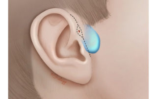 Incision for excision of a large preauricular cyst may align with the pretragal crease or be carried up onto to the tragal crest.