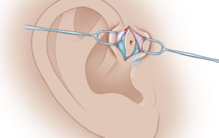 After an elliptical incision through the skin and dermis, dissection is first focused superiorly. The interface of the cyst with the helical cartilage is first identified and followed off the edge toward the temporalis fascia anteriorly. Once these superior borders of the cartilage and fascia are identified, the cyst is then circumferentially dissected.