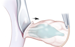 A freer elevator or scalpel can facilitate the removal of the cartilage from the undersurface of the skin of the cymba concha.