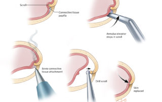 Mechanical elevation of the canal skin from the scroll can be tedious due to dense attachment. It can be achieved rapidly with needle point electrocautery. Once exposed, a diamond burr is used to remove it.