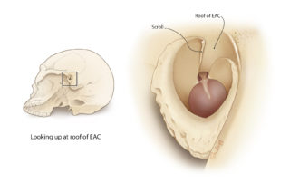 The tympanic bone is an incomplete ring which is open superiorly. At the level of the epitympanum, this aperture is called “the notch of Rivinus.” The scroll is a curled edge of the tympanic bone anterosuperiorly which is most prominent just inside the bony canal. The scroll must be removed to provide optimal view of the epitympanum.