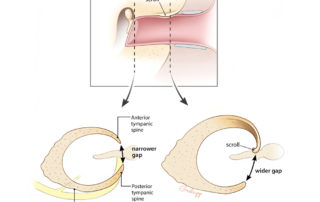The tympanic bone has a different shape at the annular level and at the bony cartilage junction. The scroll only exists laterally.