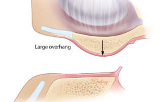 Anterior ear canal with major overhang obscuring the anterior portion of the tympanic membrane.