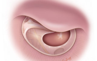 Anterior ear canal with major overhang obscuring the anterior portion of the tympanic membrane.