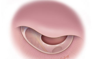 Anterior ear canal with major overhang obscuring the anterior portion of the tympanic membrane.