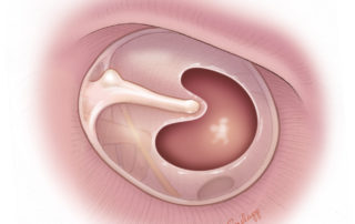Anterior ear canal with minimal overhang.