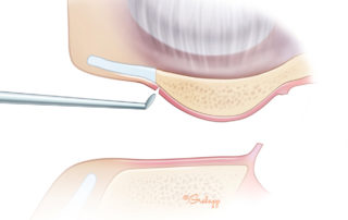 Anterior canal incision.