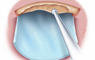 Some surgeons use a thin silicon rubber sheet to protect the skin flap while drilling.