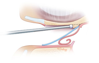 Some surgeons use a thin silicon rubber sheet to protect the skin flap while drilling.