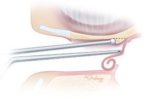 Continued excavation of canal overhang. Note use of fenestrated suction to retract skin flap.
