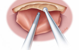 Continued excavation of canal overhang. Note use of fenestrated suction to retract skin flap.