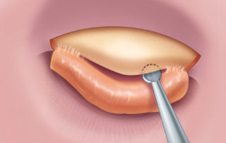 Elevation of canal skin flap.