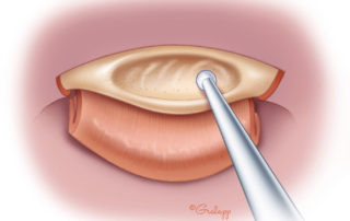 Excavation of canal overhang.
