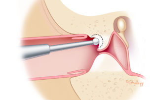 Hollowing out the exostosis.