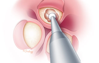 A diamond burr is used to hollow out the exostosis. Some surgeons prefer using a microchisel. It is important to remove the anterior and superior exostoses first to allow orientation to the tympanic membrane.