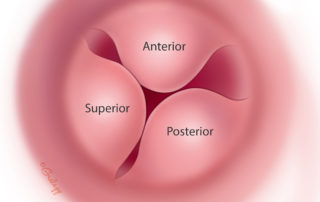 Exostoses of the ear canal are characteristically multiple. Surgery is indicated only when they are advanced and become obstructive or become stubbornly infected. Most surgeons prefer a postauricular approach, although a transcanal approach may be feasible with a large diameter canal.