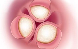 Flaps are developed by elevating the skin off the exostoses in retrograde fashion.