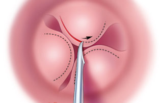 Incisions are designed to preserve as much skin as possible.