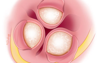 Note the relationship of the facial nerve to the posterior-inferior exostosis. While the nerve lies well deep to the superior exostosis, inferiorly the nerve may occasionally lie lateral to the tympanic annulus. A risk of iatrogenic facial nerve injury in exostosis removal exists if the surgeon does not work first anteriorly to become oriented to the tympanic membrane and becomes disoriented and drills off axis.