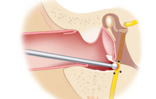Mechanism of facial nerve injury in exostoses removal. This is avoidable by first orienting to the tympanic membrane by first removing the anterior and superior exostoses.
