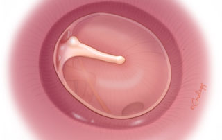 The extent of canaloplasty should be slightly greater than the annulus margin.