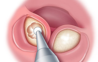 The superior exostosis is removed next.