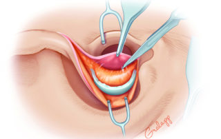 Elevation of soft tissue deep to the excised conchal cartilage from the ear canal skin.