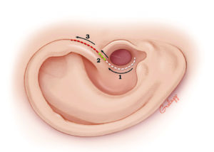 Incision for endaural meatoplasty.