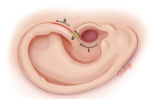 Incision for endaural meatoplasty.