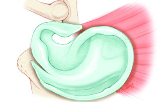 The superior incision is made in the incisura: the interval between the anterior crus of the helix and the superior aspect of the tragus. The inferior incision tracks toward the conchal edge.