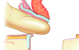 Schematic view of thinning the postauricular soft tissue toward the conchal cartilage.