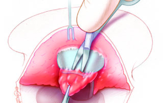 The perichondrium is dissected off the undersurface of the conchal bowl until its free edge is reached.