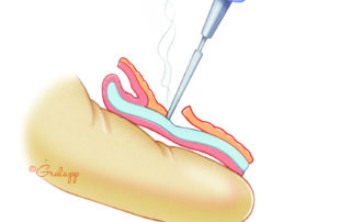 Incision is made through the perichondrium to exposure the conchal cartilage.