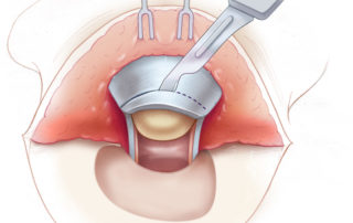 Pushing outward with the finger, the cartilage is incised part way through its thickness. The amount of cartilage to be removed depends on the size of the meatus desired.