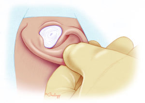 Meatal packing in place. This can be removed as early as a few days later.