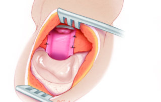 Completed anterior meatoplasty.