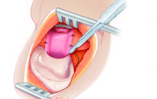 The lower aspect of the temporalis muscle is resected so that it will on impinge on the surgically enlarged meatus.