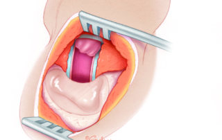 Anterior meatoplasty is needed to balance the size of the anterior meatus with the now larger posterior meatus.