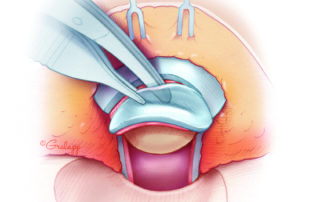 Dissection of the conchal cartilage off the underlying perichondrium.