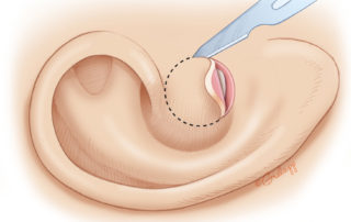 Creation of the meatus.