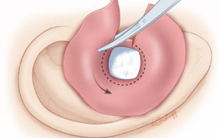 Unfurling of the skin graft, which is trimmed to match the meatal edge.