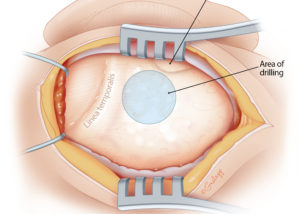 To locate the initial drilling location for the new ear canal in congenital aural atresia, first orient to the glenoid fossa and the linea temporalis.