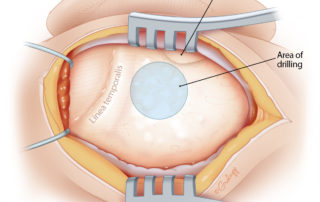 To locate the initial drilling location for the new ear canal in congenital aural atresia, first orient to the glenoid fossa and the linea temporalis.