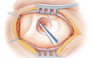 For the safest approach to the tympanum, the deepest point of drill excavation should be kept superior and anterior.