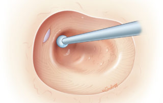 Note the identification of the tegmen dura (usually through a thin sheet of bone) to assure that the neocanal is positioned properly. If the drilling becomes offline, oriented too inferiorly, then the facial nerve may be placed in jeopardy.