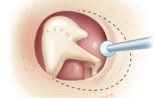 Completing removal of the inferior aspect of the neocanal.