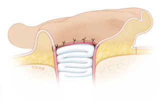 Completed meatal construction.