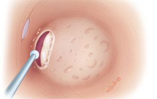 The atresia plate is breached superiorly along the tegmen with identification of the malleus head and incus body, which are fused in patients with atresia.