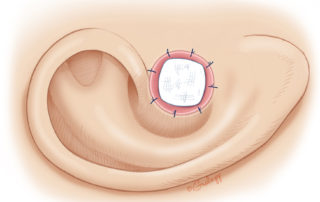 The skin graft is sutured to the meatal skin.